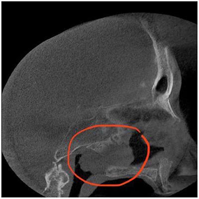 Case Report: Oncocytic Schneiderian Papilloma Originating From the Sphenoid Sinus